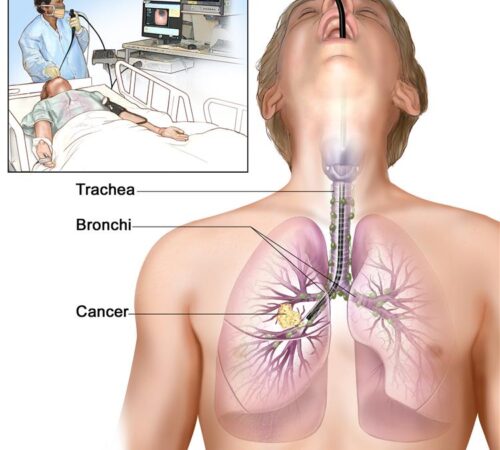 bronchoscopy-02 bronchoscopy-02