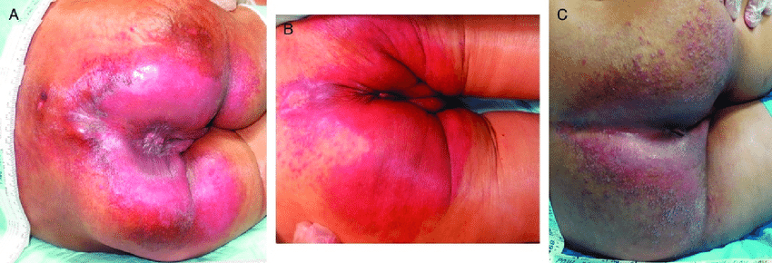 Incontinence Associated Dermatitis