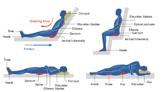 Pressure Areas