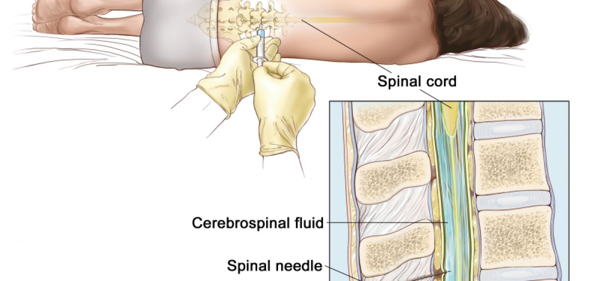 Lumbar Puncture