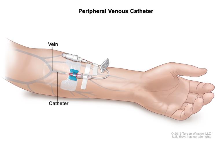 peripheral-catheter-insertion-01