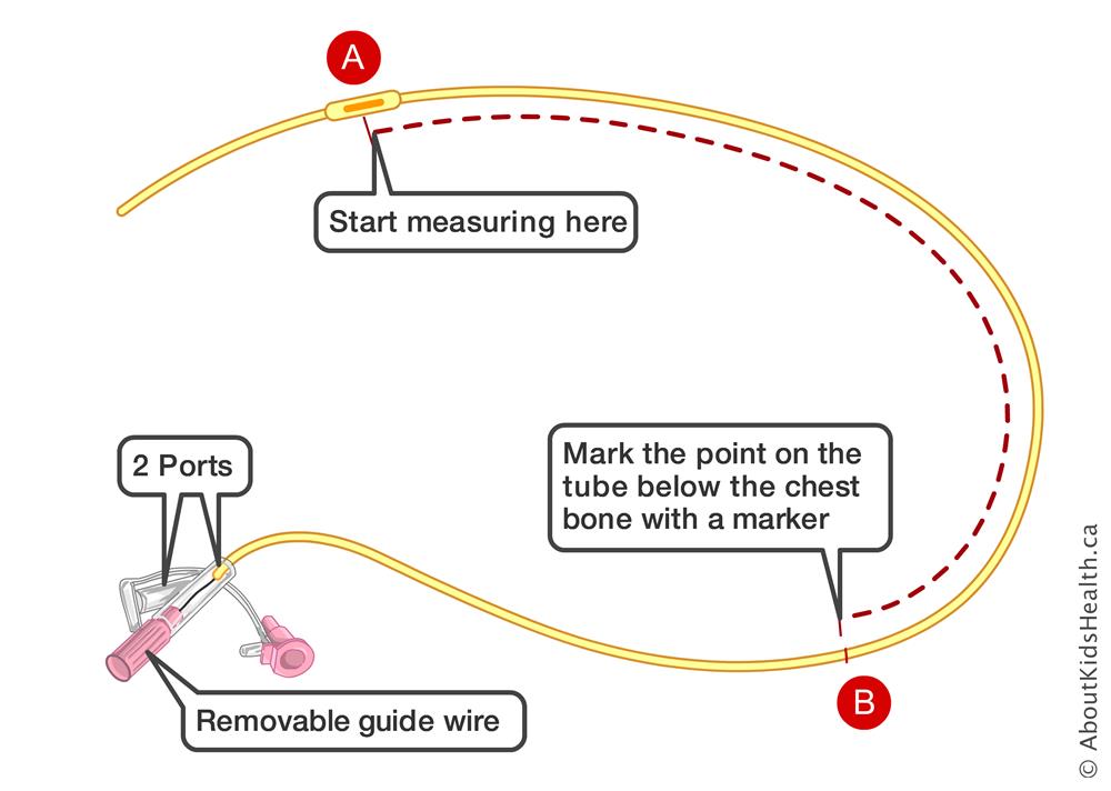ryles-tube-insertion-01