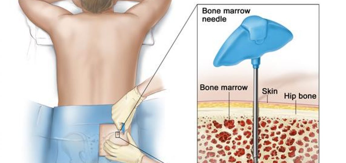 Bone Marrow Biopsy